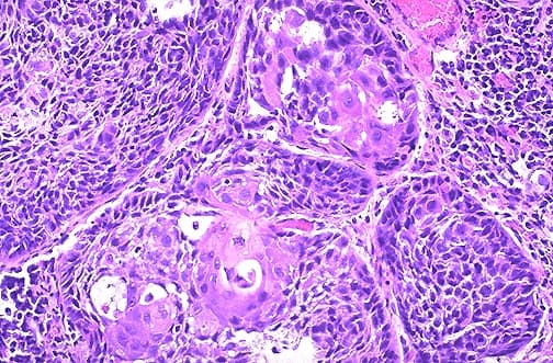 Lung squamous cell carcinoma