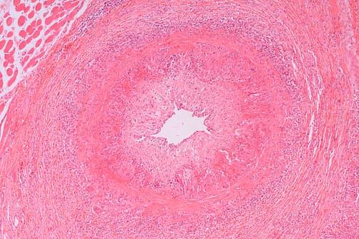 Polyarteritis Nodosa (PAN)